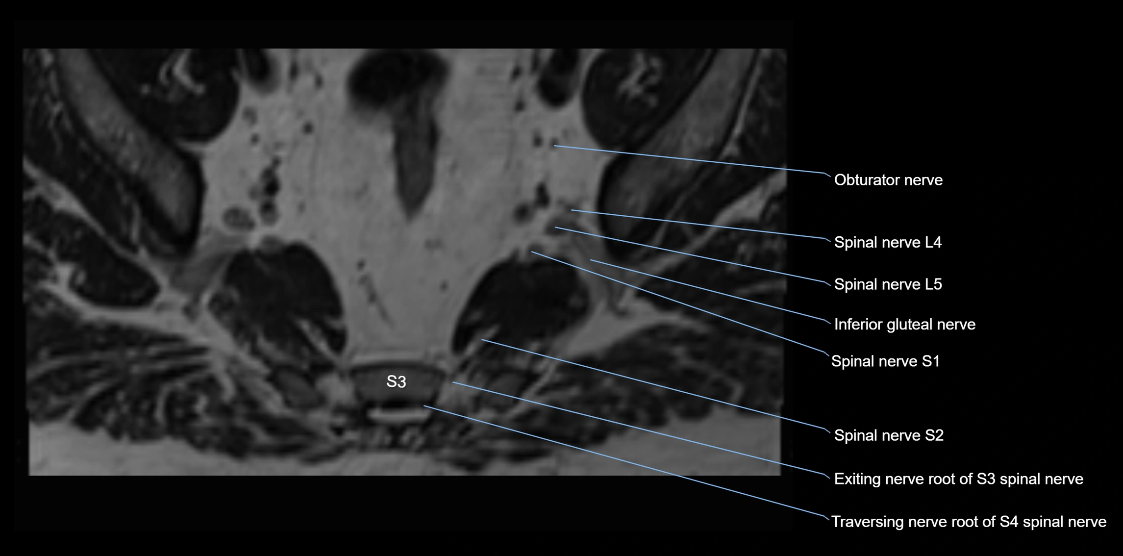 MR lumbosacral plexus axial cross sectional anatomy 3T  radiology  image-img-1008001-00094.webp